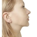 All You Need to Know About Kybella